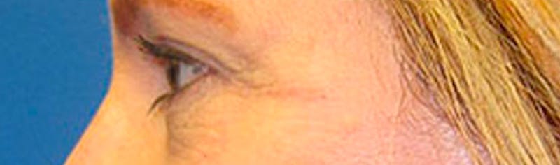 Upper Eyelid Surgery Before & After Gallery - Patient 268555 - Image 6