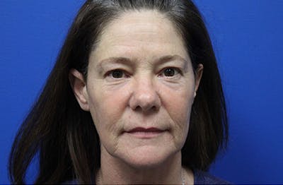 Facelift Before & After Gallery - Patient 303242 - Image 1