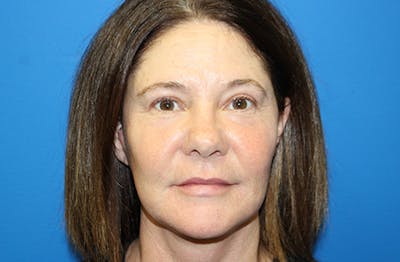 Facelift Before & After Gallery - Patient 303242 - Image 2