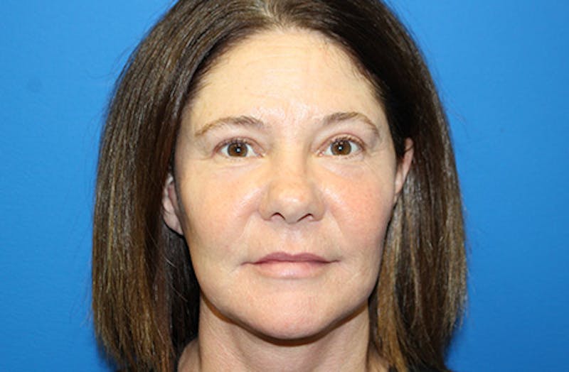 Facelift Before & After Gallery - Patient 303242 - Image 2