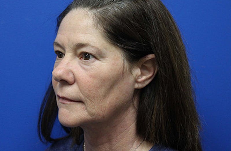 Facelift Before & After Gallery - Patient 303242 - Image 3