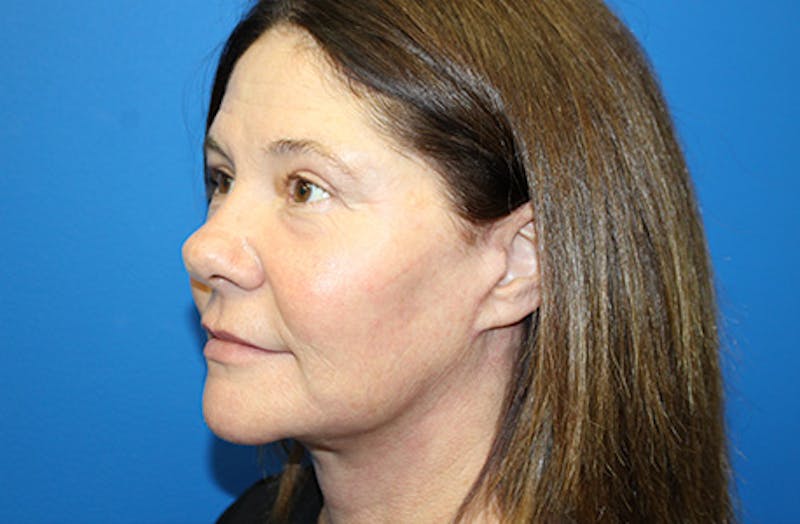 Facelift Before & After Gallery - Patient 303242 - Image 4