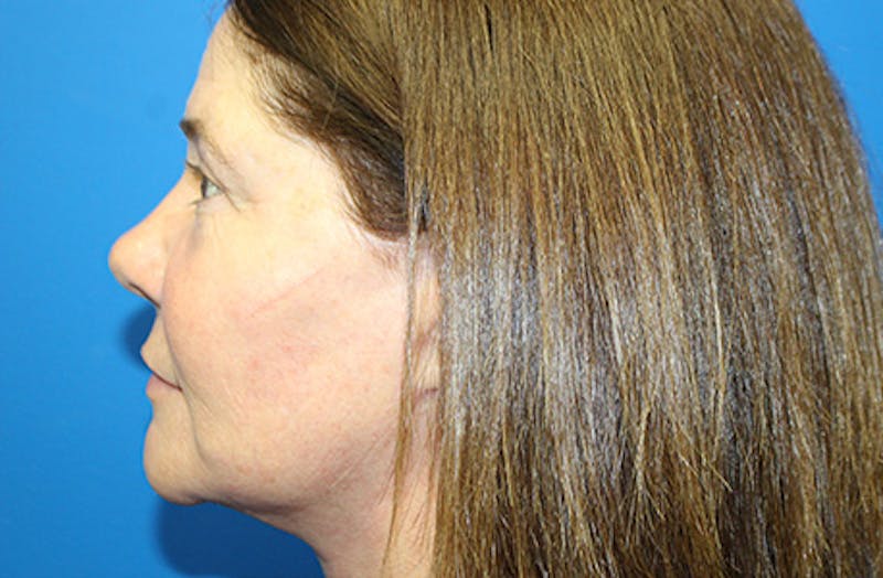 Facelift Before & After Gallery - Patient 303242 - Image 6