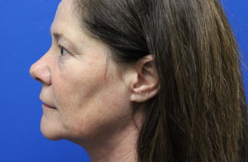 Facelift Before & After Gallery - Patient 303242 - Image 5