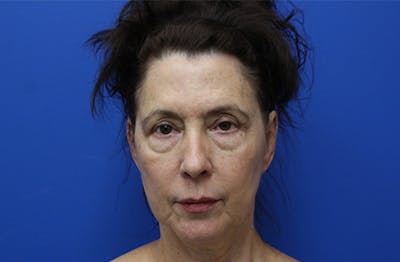 Facelift Before & After Gallery - Patient 285469 - Image 1