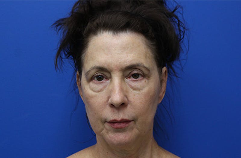 Facelift Before & After Gallery - Patient 285469 - Image 1