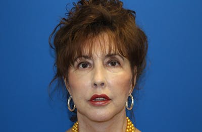 Facelift Before & After Gallery - Patient 285469 - Image 2