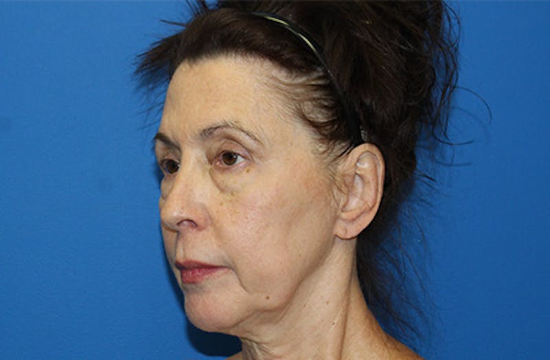 Facelift Before & After Gallery - Patient 285469 - Image 3