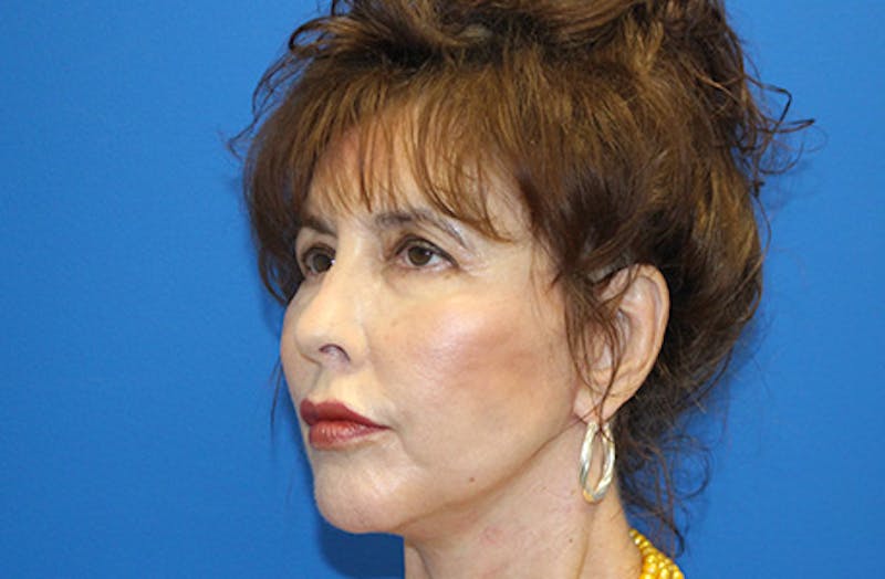 Facelift Before & After Gallery - Patient 285469 - Image 4