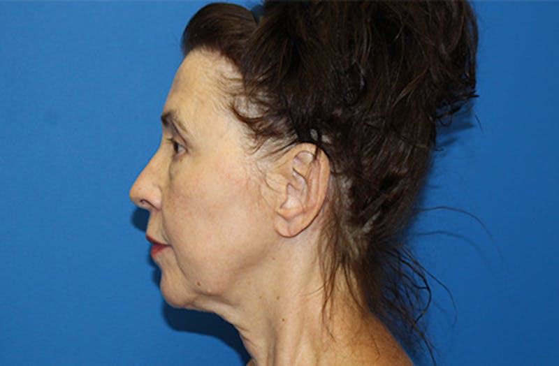 Facelift Before & After Gallery - Patient 285469 - Image 5