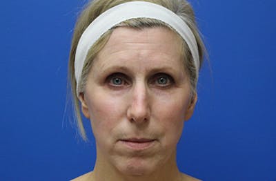 Facelift Before & After Gallery - Patient 933971 - Image 1