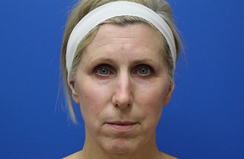 Facelift Before & After Gallery - Patient 933971 - Image 1
