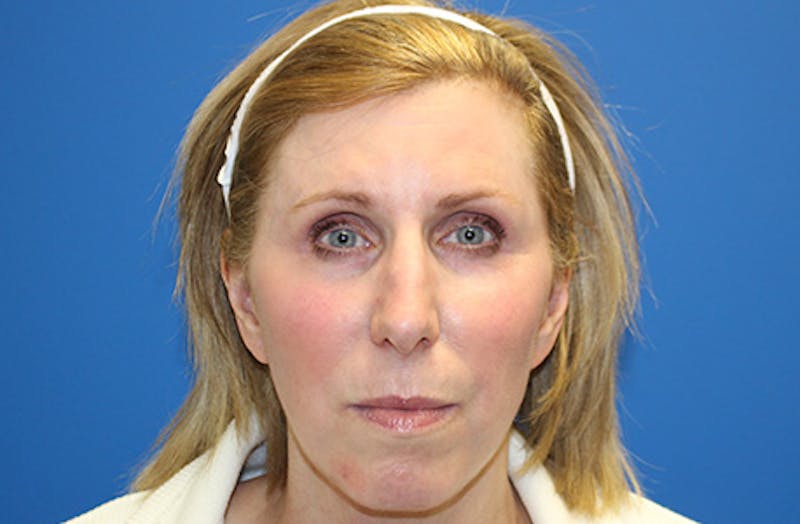 Facelift Before & After Gallery - Patient 933971 - Image 2