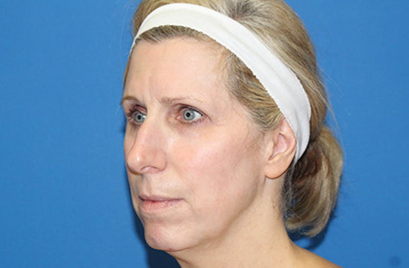 Facelift Before & After Gallery - Patient 933971 - Image 3