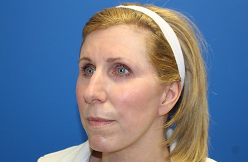 Facelift Before & After Gallery - Patient 933971 - Image 4