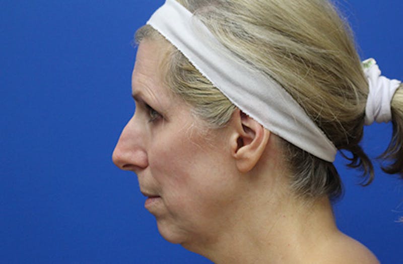 Facelift Before & After Gallery - Patient 933971 - Image 5