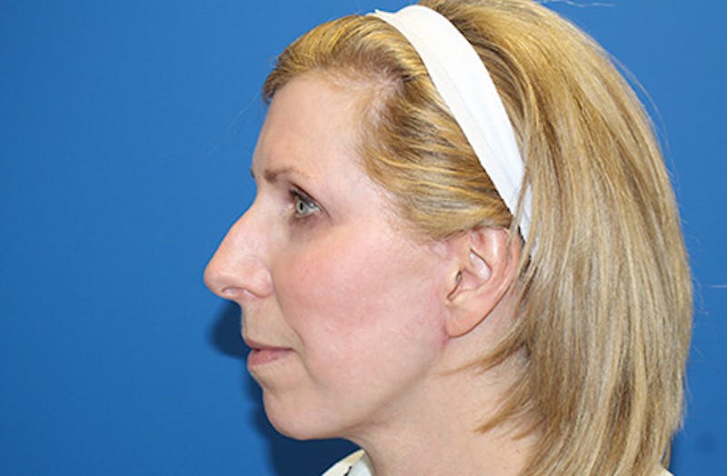 Facelift Before & After Gallery - Patient 933971 - Image 6