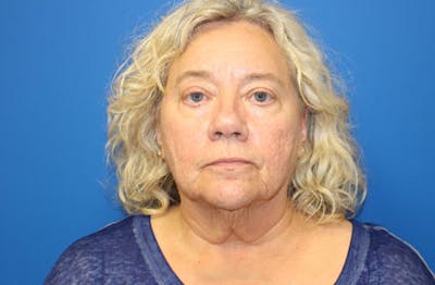 Facelift Before & After Gallery - Patient 285686 - Image 1