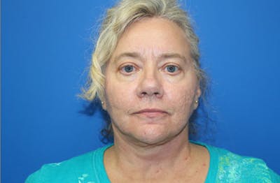 Facelift Before & After Gallery - Patient 285686 - Image 2