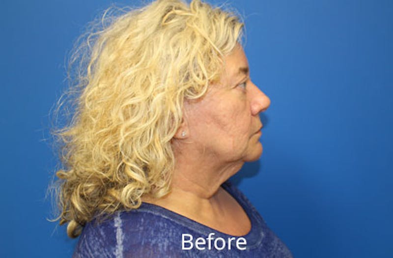 Facelift Before & After Gallery - Patient 285686 - Image 3