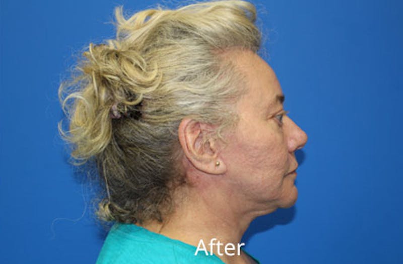 Facelift Before & After Gallery - Patient 285686 - Image 4