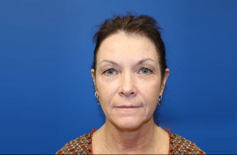 Facelift Before & After Gallery - Patient 907421 - Image 1