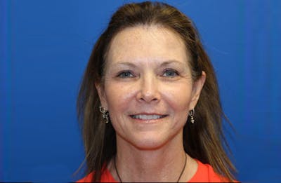 Facelift Before & After Gallery - Patient 907421 - Image 2
