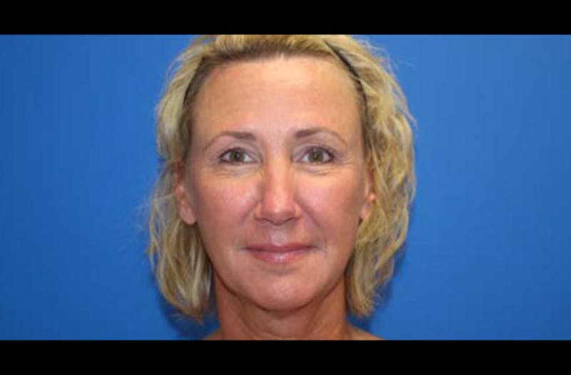 Facelift Before & After Gallery - Patient 185865 - Image 1