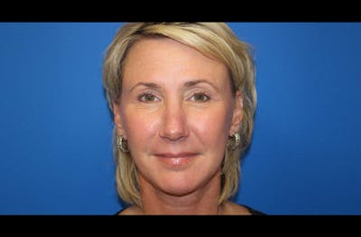 Facelift Before & After Gallery - Patient 185865 - Image 2