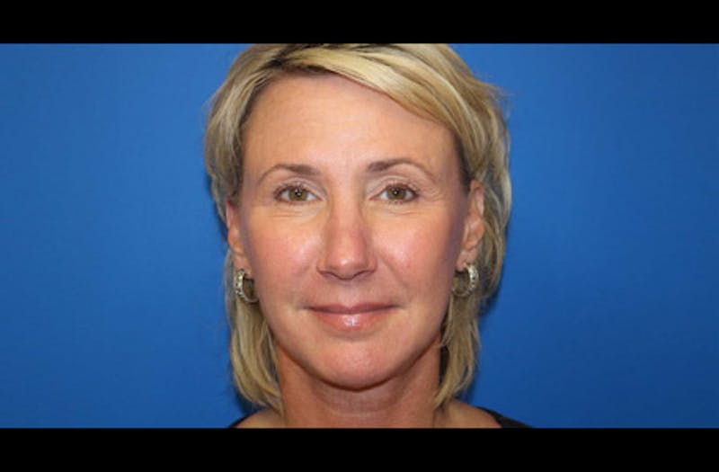 Facelift Before & After Gallery - Patient 185865 - Image 2