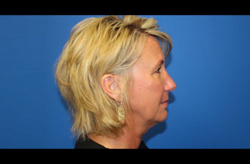 Facelift Before & After Gallery - Patient 185865 - Image 3