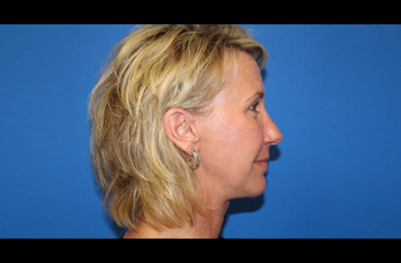 Facelift Before & After Gallery - Patient 185865 - Image 4