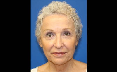 Facelift Before & After Gallery - Patient 236655 - Image 1