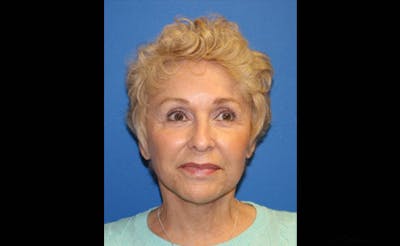 Facelift Before & After Gallery - Patient 236655 - Image 2