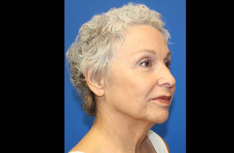 Facelift Before & After Gallery - Patient 236655 - Image 3