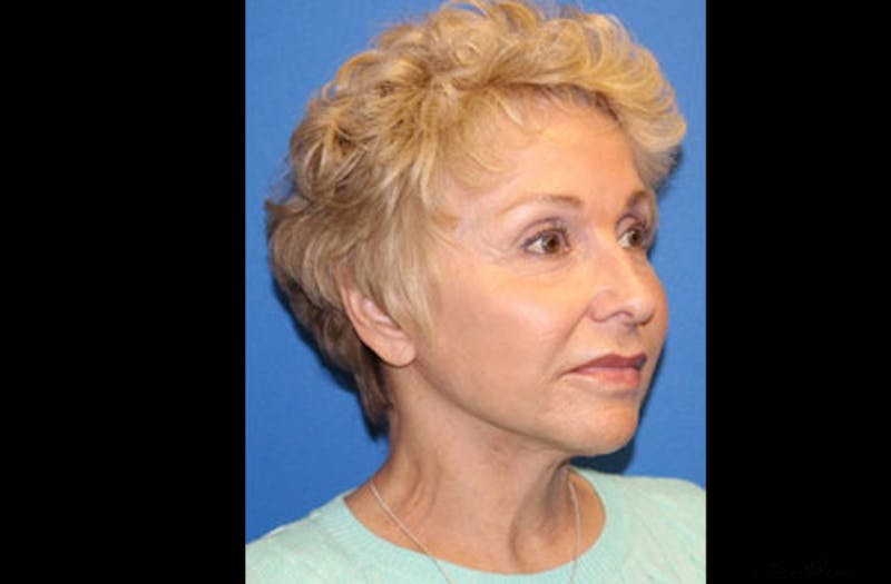Facelift Before & After Gallery - Patient 236655 - Image 4