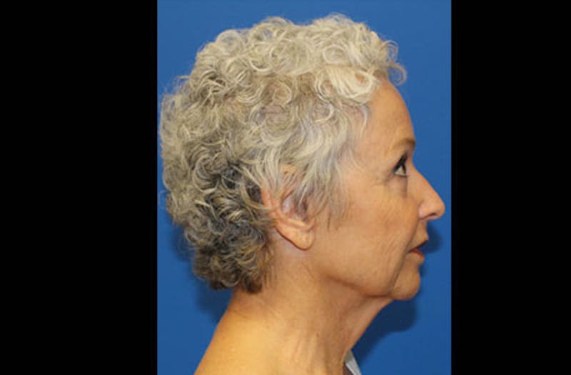 Facelift Before & After Gallery - Patient 236655 - Image 5