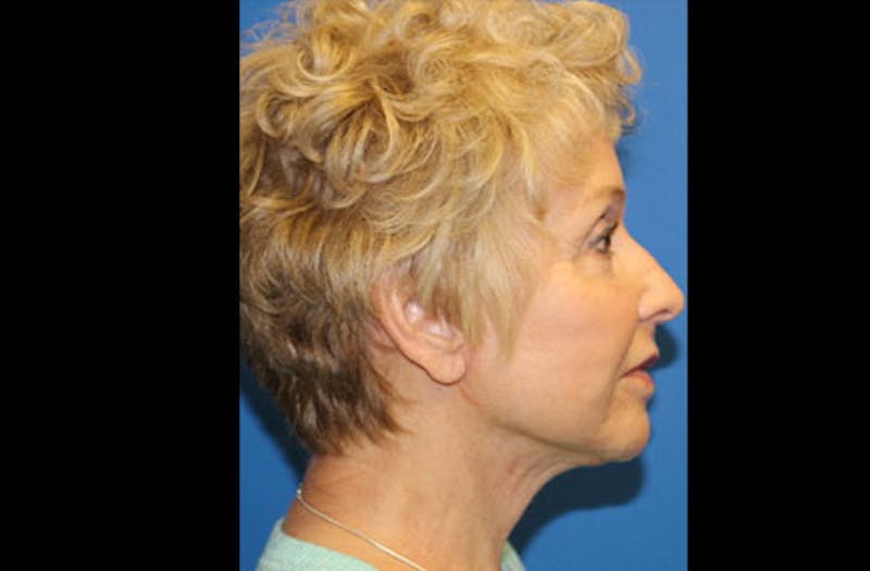 Facelift Before & After Gallery - Patient 236655 - Image 6