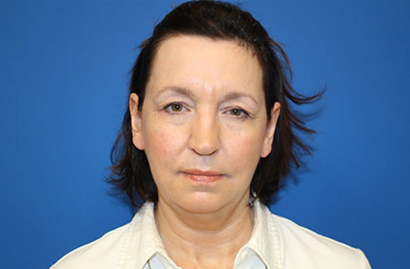 Facelift Before & After Gallery - Patient 384972 - Image 1