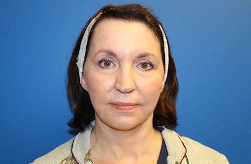 Facelift Before & After Gallery - Patient 384972 - Image 2