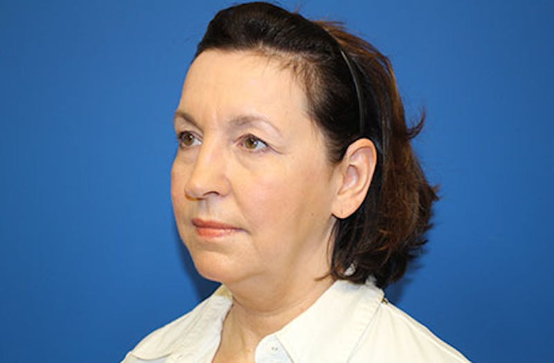 Facelift Before & After Gallery - Patient 384972 - Image 3