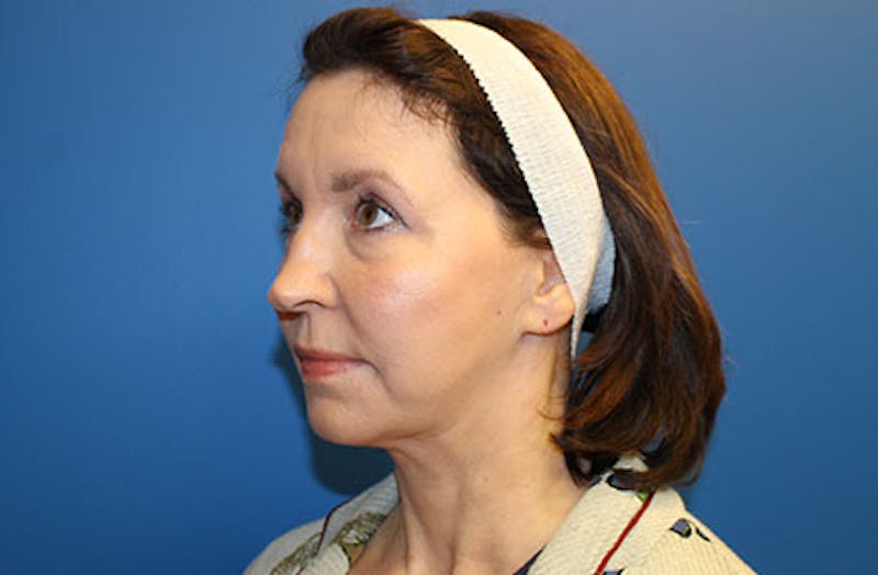 Facelift Before & After Gallery - Patient 384972 - Image 4
