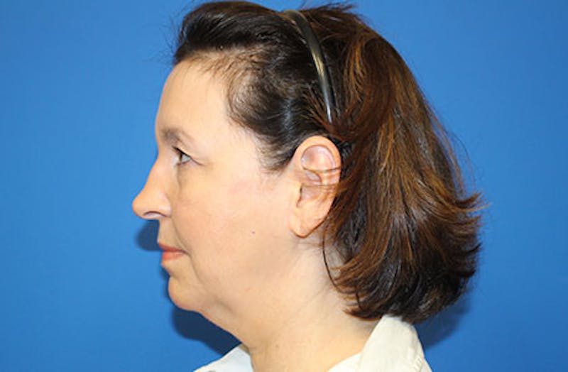 Facelift Before & After Gallery - Patient 384972 - Image 5