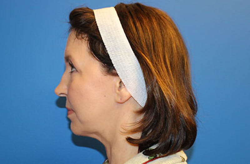 Facelift Before & After Gallery - Patient 384972 - Image 6