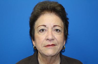 Facelift Before & After Gallery - Patient 200250 - Image 1