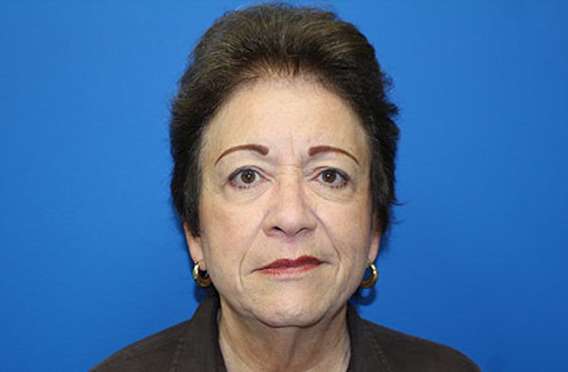 Facelift Before & After Gallery - Patient 200250 - Image 1
