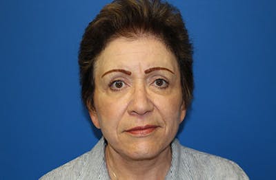 Facelift Before & After Gallery - Patient 200250 - Image 2