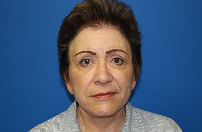 Facelift Before & After Gallery - Patient 200250 - Image 2