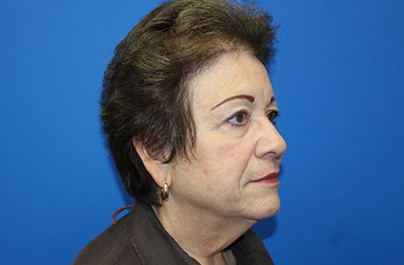 Facelift Before & After Gallery - Patient 200250 - Image 3
