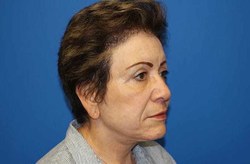Facelift Before & After Gallery - Patient 200250 - Image 4